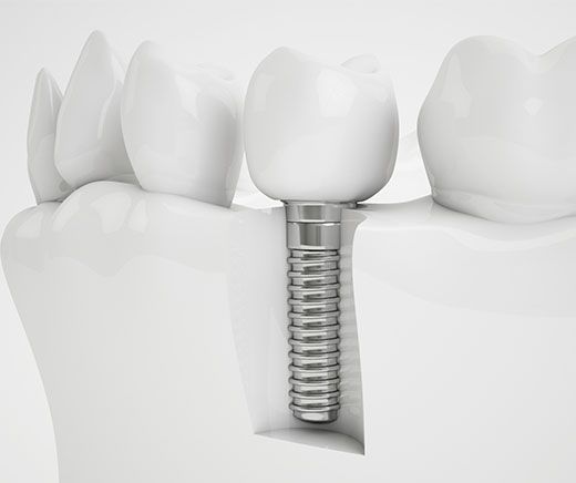 Implantes dentales