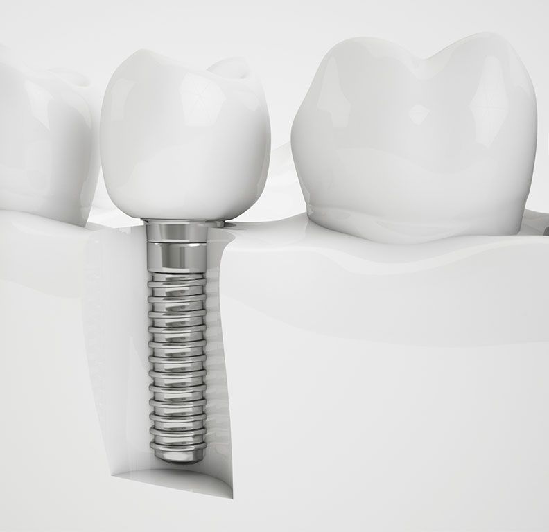 Clínicas Reydental - Implantes dentales